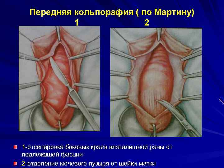 Передняя кольпорафия ( по Мартину) 1 2 1 -отсепаровка боковых краев влагалищной раны от