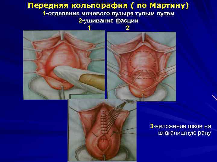 Передняя кольпорафия ( по Мартину) 1 -отделение мочевого пузыря тупым путем 2 -ушивание фасции