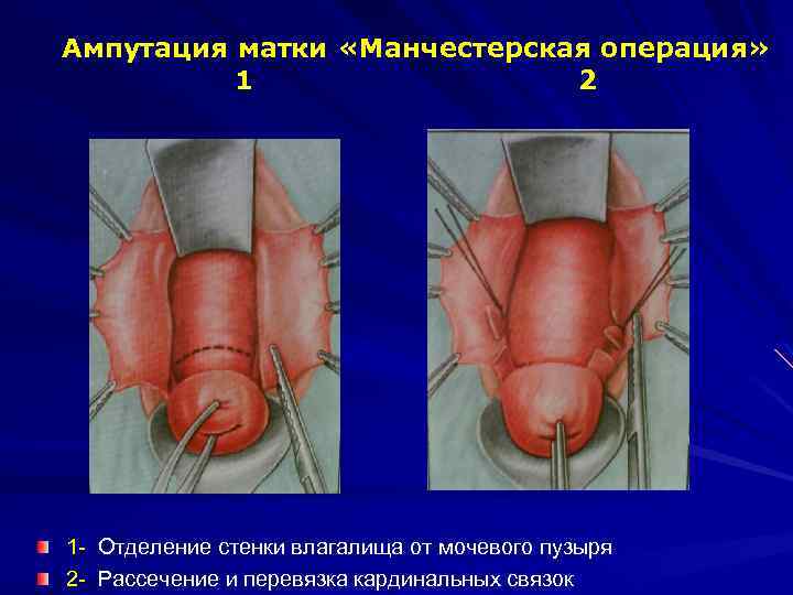 Ампутация матки «Манчестерская операция» 1 2 1 - Отделение стенки влагалища от мочевого пузыря