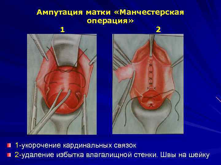 Ампутация матки «Манчестерская операция» 1 2 1 -укорочение кардинальных связок 2 -удаление избытка влагалищной