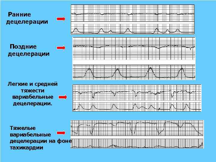  Ранние децелерации Поздние децелерации Легкие и средней тяжести вариабельные децелерации. Тяжелые вариабельные децелерации