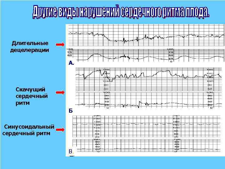  Длительные децелерации А. Скачущий сердечный ритм Б Синусоидальный сердечный ритм В. 