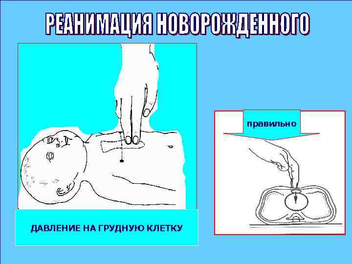 правильно ДАВЛЕНИЕ НА ГРУДНУЮ КЛЕТКУ 