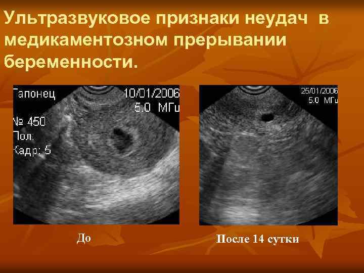 Беременность через месяц после замершей беременности