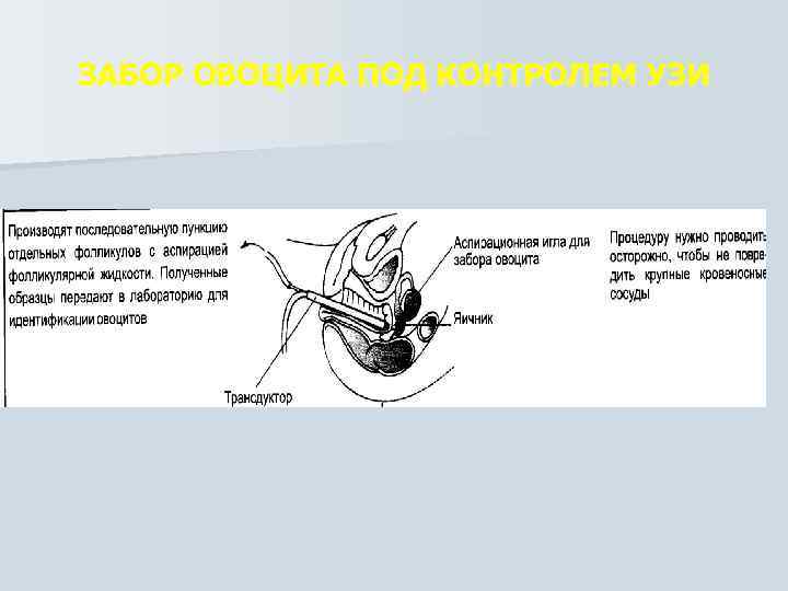 ЗАБОР ОВОЦИТА ПОД КОНТРОЛЕМ УЗИ 