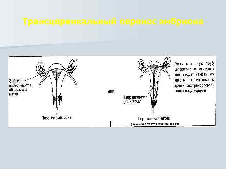Трансцервикальный перенос эмбриона 