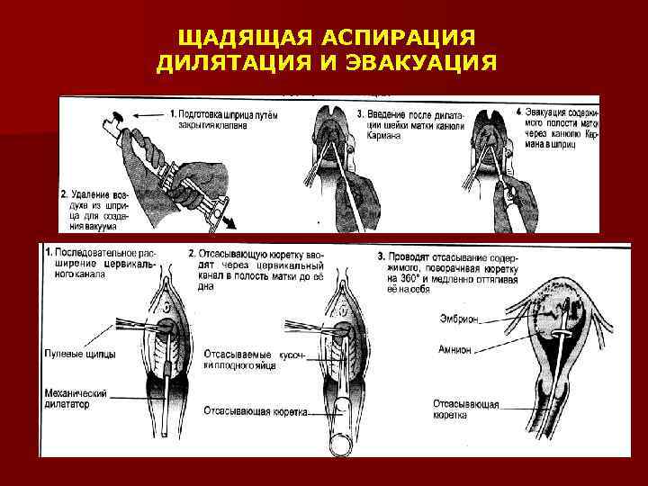 ЩАДЯЩАЯ АСПИРАЦИЯ ДИЛЯТАЦИЯ И ЭВАКУАЦИЯ 