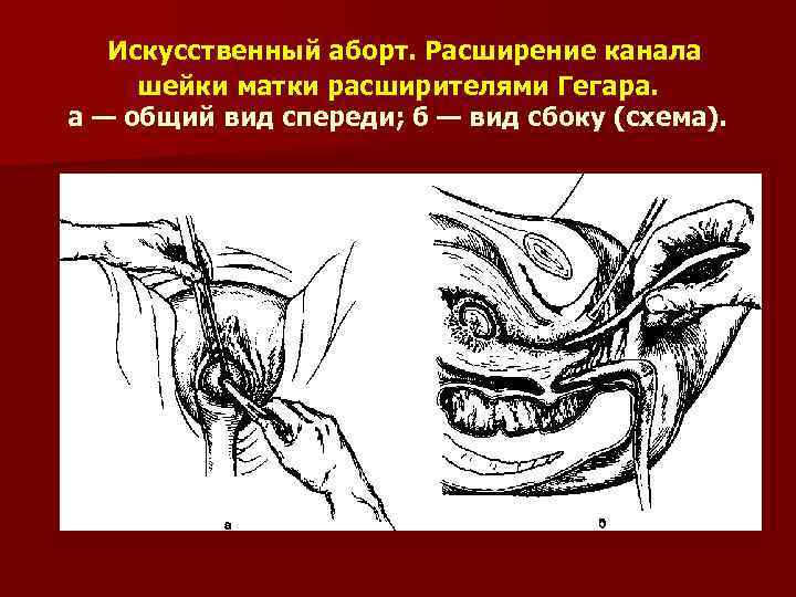 Искусственный аборт. Расширение канала шейки матки расширителями Гегара. а — общий вид спереди; б