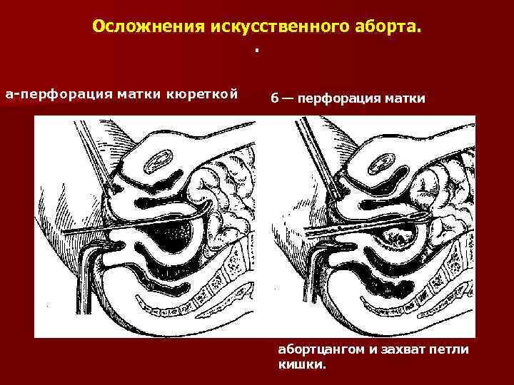 Осложнения искусственного аборта. . а перфорация матки кюреткой б — перфорация матки а— абортцангом