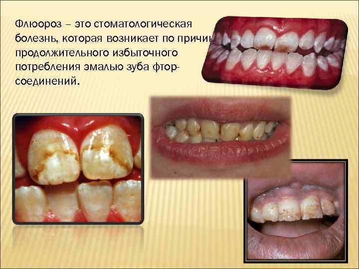 Флюороз – это стоматологическая болезнь, которая возникает по причине продолжительного избыточного потребления эмалью зуба