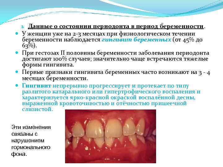  ь Данные о состоянии периодонта в период беременности. У женщин уже на 2