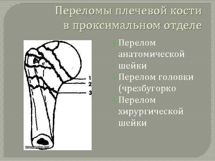 Переломы плечевой кости в проксимальном отделе Перелом анатомической шейки Перелом головки (чрезбугорко Перелом хирургической