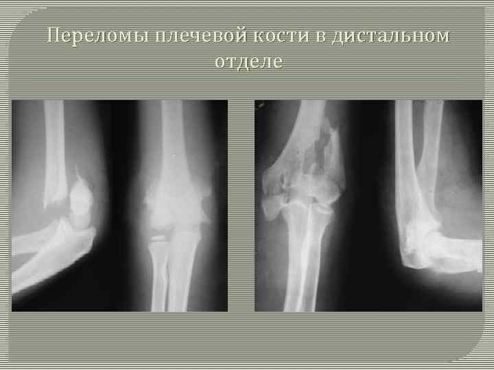 Переломы плечевой кости в дистальном отделе 