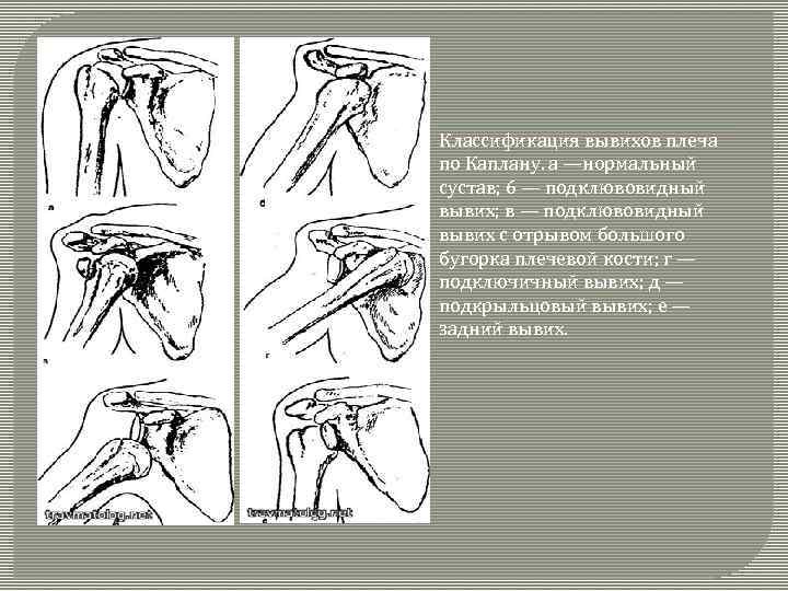Классификация вывихов плеча по Каплану. а —нормальный сустав; 6 — подклювовидный вывих; в —