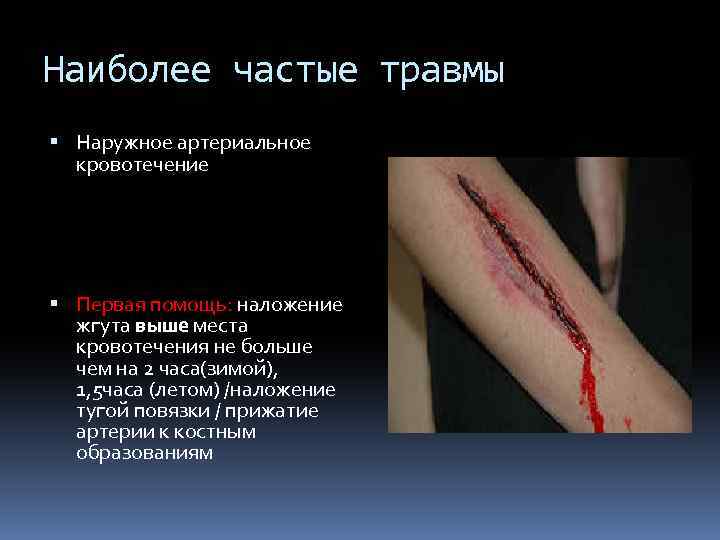 Наиболее частые травмы Наружное артериальное кровотечение Первая помощь: наложение жгута выше места кровотечения не