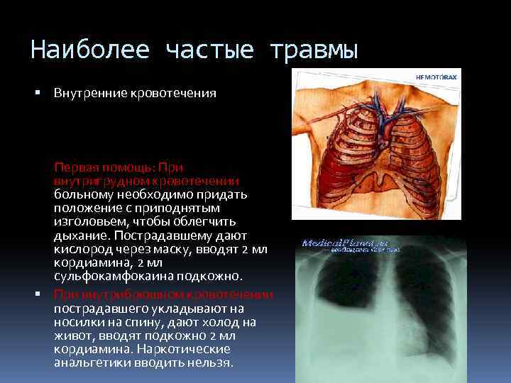 Наиболее частые травмы Внутренние кровотечения Первая помощь: При внутригрудном кровотечении больному необходимо придать положение