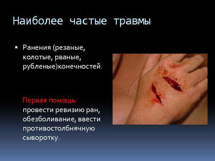 Наиболее частые травмы Ранения (резаные, колотые, рваные, рубленые)конечностей. Первая помощь: провести ревизию ран, обезболивание,