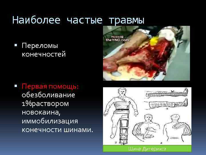 Наиболее частые травмы Переломы конечностей Первая помощь: обезболивание 1%раствором новокаина, иммобилизация конечности шинами. Шина
