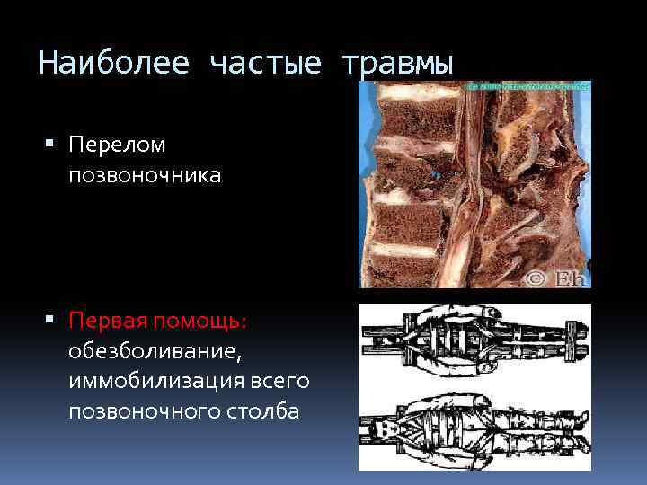 Наиболее частые травмы Перелом позвоночника Первая помощь: обезболивание, иммобилизация всего позвоночного столба 