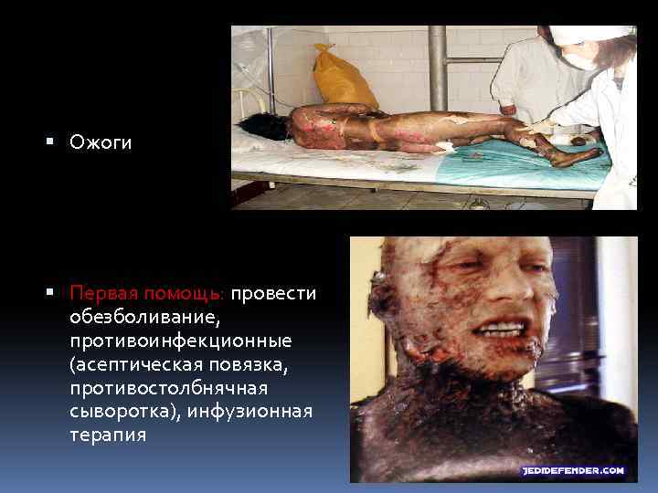  Ожоги Первая помощь: провести обезболивание, противоинфекционные (асептическая повязка, противостолбнячная сыворотка), инфузионная терапия 