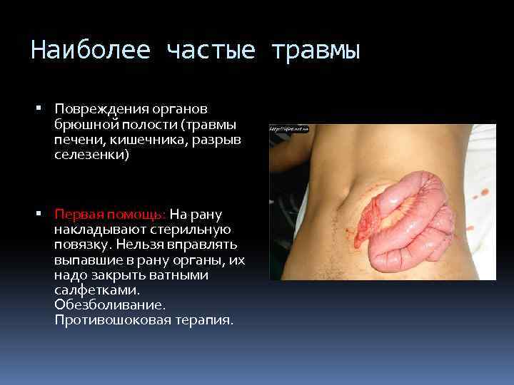 Наиболее частые травмы Повреждения органов брюшной полости (травмы печени, кишечника, разрыв селезенки) Первая помощь: