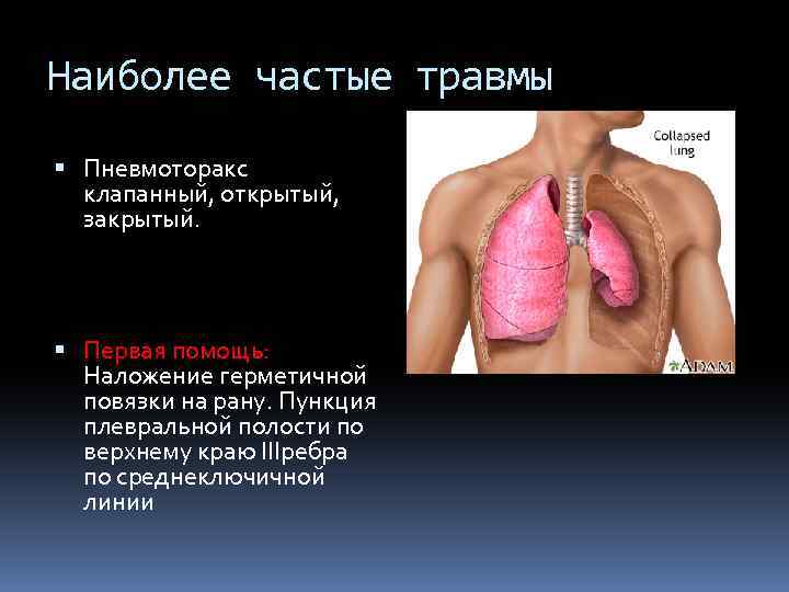 Наиболее частые травмы Пневмоторакс клапанный, открытый, закрытый. Первая помощь: Наложение герметичной повязки на рану.