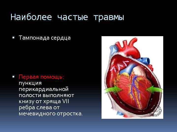 Наиболее частые травмы Тампонада сердца Первая помощь: пункция перикардиальной полости выполняют книзу от хряща