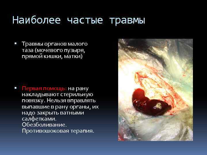 Наиболее частые травмы Травмы органов малого таза (мочевого пузыря, прямой кишки, матки) Первая помощь:
