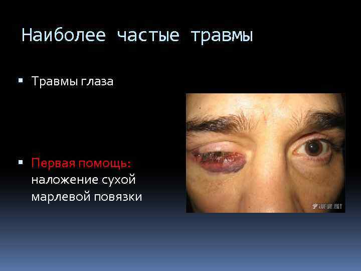 Наиболее частые травмы Травмы глаза Первая помощь: наложение сухой марлевой повязки 