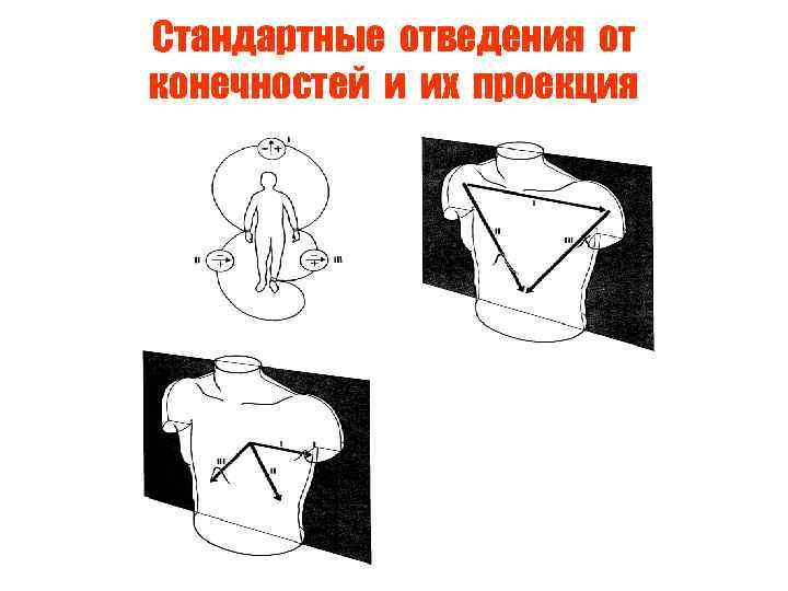 Стандартные отведения от конечностей и их проекция 