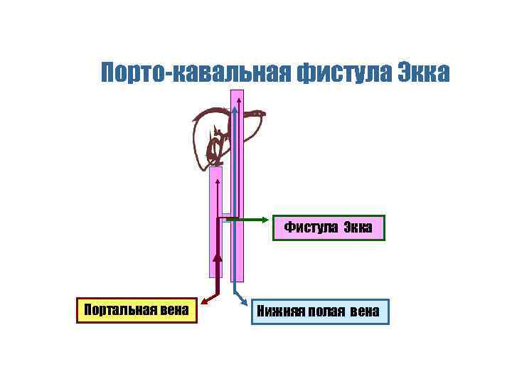 Порто-кавальная фистула Экка Фистула Экка Портальная вена Нижняя полая вена 