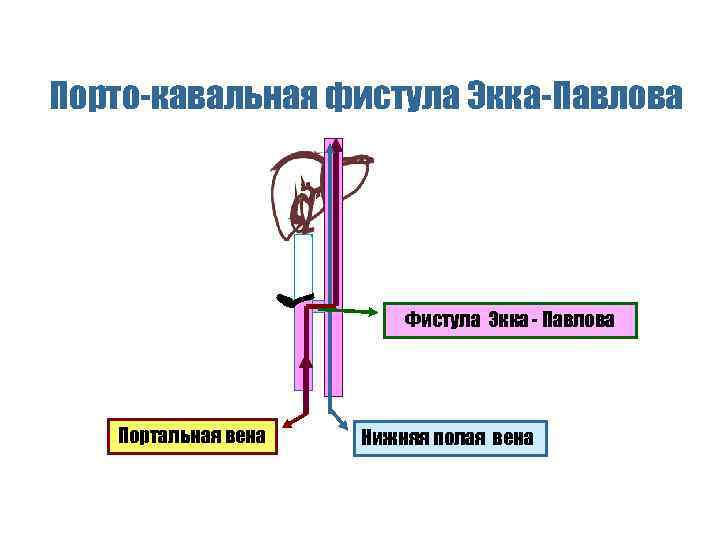 Порто-кавальная фистула Экка-Павлова Фистула Экка - Павлова Портальная вена Нижняя полая вена 