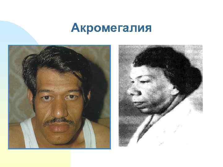 Акромегалия 