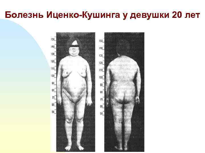 Болезнь Иценко-Кушинга у девушки 20 лет 