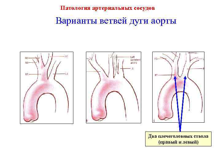 Патология артериальных сосудов Варианты ветвей дуги аорты Два плечеголовных ствола (правый и левый) 