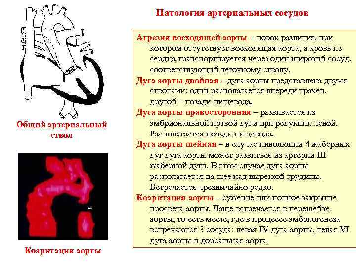 Патология артериальных сосудов Общий артериальный ствол Коарктация аорты Атрезия восходящей аорты – порок развития,