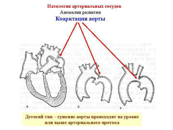 Патология артериальных сосудов Аномалии развития Коарктация аорты Детский тип – сужение аорты происходит на