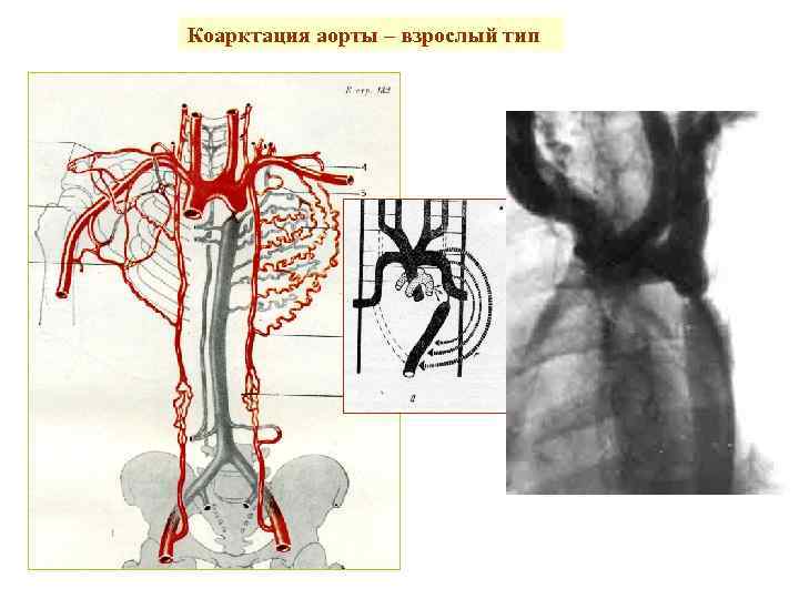 Коарктация аорты – взрослый тип 