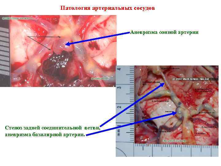 Патология артериальных сосудов Аневризма сонной артерии Стеноз задней соединительной ветви, аневризма базилярной артерии. 