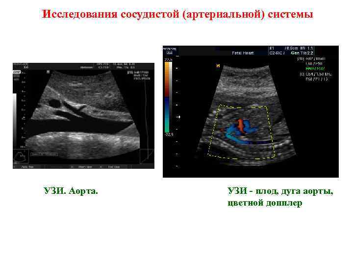 Исследования сосудистой (артериальной) системы УЗИ. Аорта. УЗИ - плод, дуга аорты, цветной допплер 