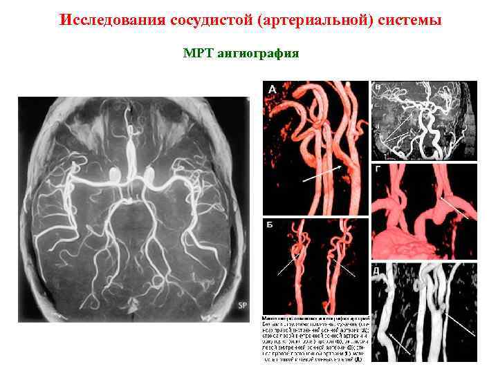 Исследования сосудистой (артериальной) системы МРТ ангиография 