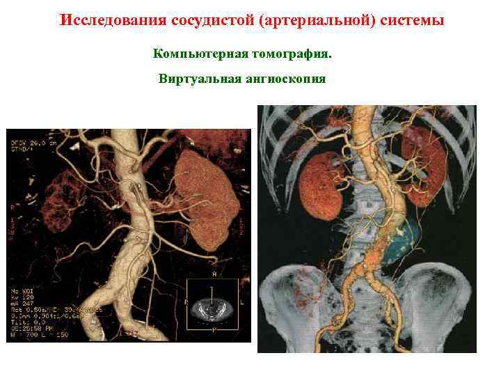 Исследования сосудистой (артериальной) системы Компьютерная томография. Виртуальная ангиоскопия 