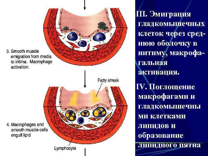 III. Эмиграция гладкомышечных клеток через среднюю оболочку в интиму, макрофагальная активация. IV. Поглощение макрофагами