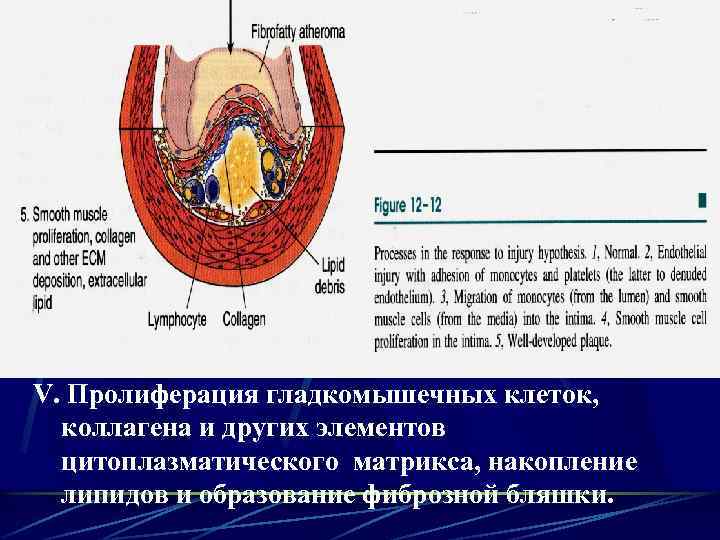 V. Пролиферация гладкомышечных клеток, коллагена и других элементов цитоплазматического матрикса, накопление липидов и образование