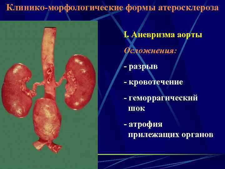 Клинико-морфологические формы атеросклероза I. Аневризма аорты Осложнения: - разрыв - кровотечение - геморрагический шок