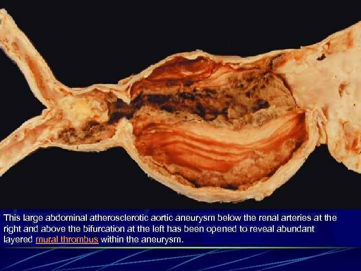 This large abdominal atherosclerotic aortic aneurysm below the renal arteries at the right and