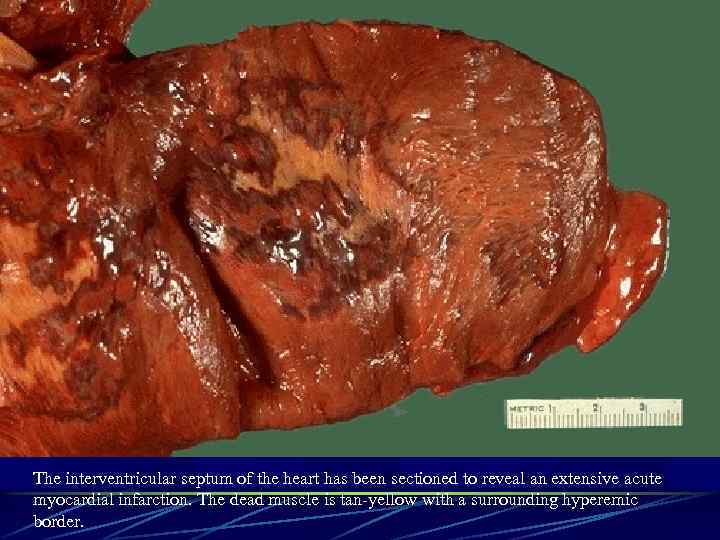 The interventricular septum of the heart has been sectioned to reveal an extensive acute