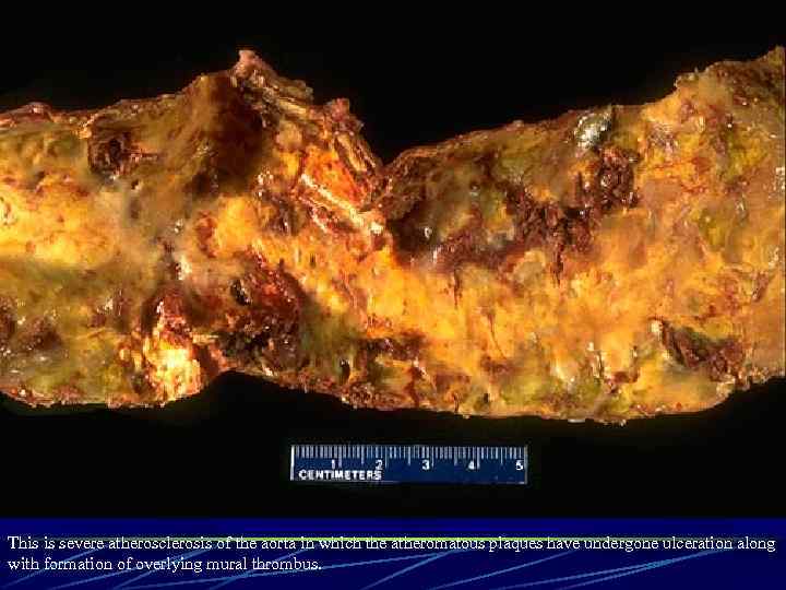 This is severe atherosclerosis of the aorta in which the atheromatous plaques have undergone