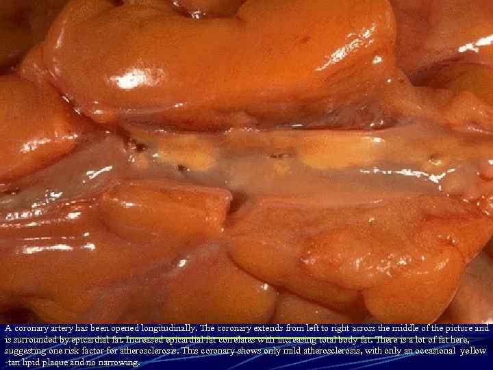 A coronary artery has been opened longitudinally. The coronary extends from left to right