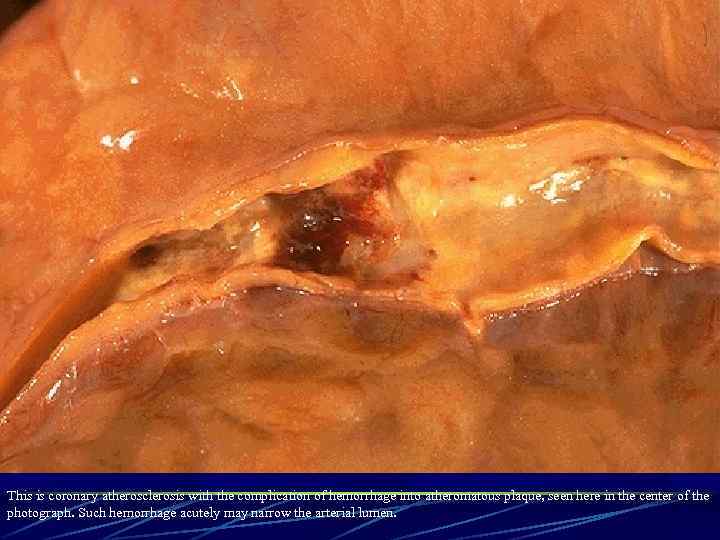 This is coronary atherosclerosis with the complication of hemorrhage into atheromatous plaque, seen here